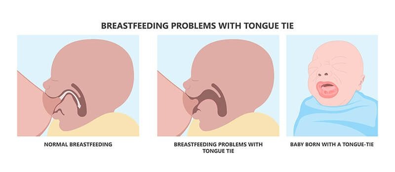 tongue-tie
